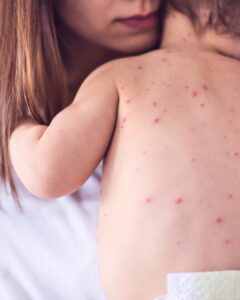 Someone with the reddish color hair holding a baby with measles spots on their back