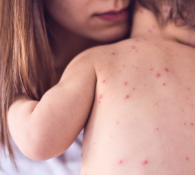 Understanding Measles: How to stay protected